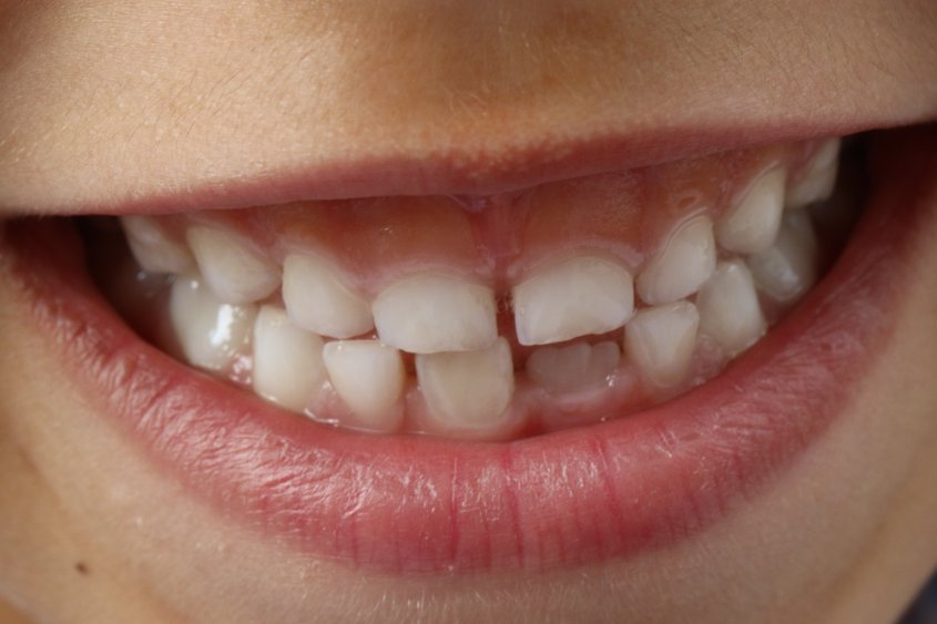 Profilaktyka zębów u dzieci